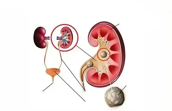 কিডনিতে পাথর হলে কী করা?