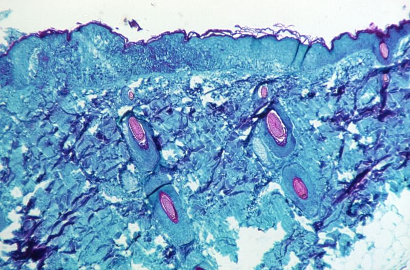 A section of skin tissue, harvested from a lesion on the skin of a monkey, that had been infected with monkeypox virus, is seen at 50X magnification on day four of rash development in 1968