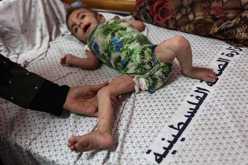 Palestinian baby girl Wateen al-Adasi who developed a skin condition due to malnutrition rests at the Kamal Adwan hospital in Beit Lahia in the northern Gaza Strip on 2 July, 2024. More than 150,000 people in the Gaza Strip have contracted skin diseases in the squalid conditions into which displaced people have been forced since the Israel-Hamas war erupted in October, according to the WHO, while Gaza’s children are already highly vulnerable to disease because their immune systems are compromised by malnutrition, the Doctors Without Borders (MSF) medical coordinator in the besieged Palestinian territory said