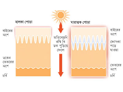 অতিবেগুনি রশ্মি এ অকালে বুড়িয়ে যাওয়া ও ক্যানসারের জন্য দায়ী