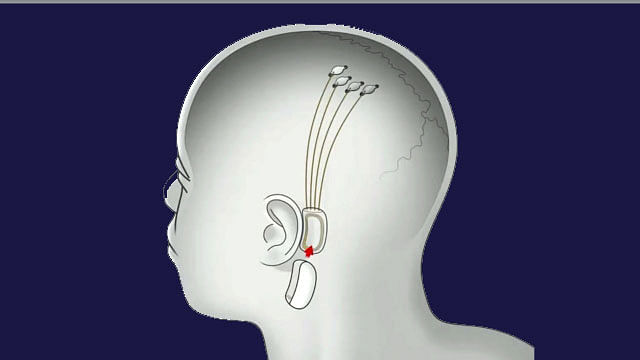 মস্তিষ্ক ও যন্ত্রের সংযোগ স্থাপনের ব্যাপারে নতুন ধারণার কথা শুনিয়েছে এলন মাস্কের প্রতিষ্ঠান। ছবি: নিউরালিংকের সৌজন্যে