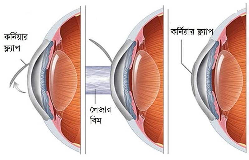 ল্যাসিকের বিভিন্ন ধাপ
