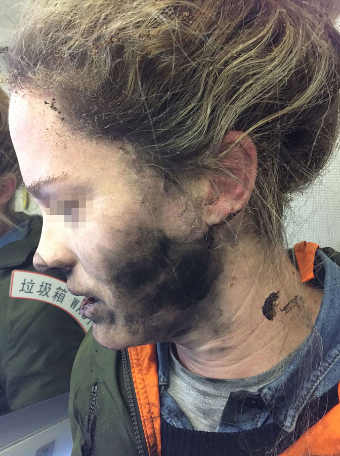 This handout photo taken on February 19, 2017 and released by the Australia Transport Safety Bureau (ATSB) shows a woman after she suffered burns to her face and hands after her headphones caught fire during a flight to Australia, officials said on March 15, 2017. Photo: AFP/ Australia Transport Safety Bureau”