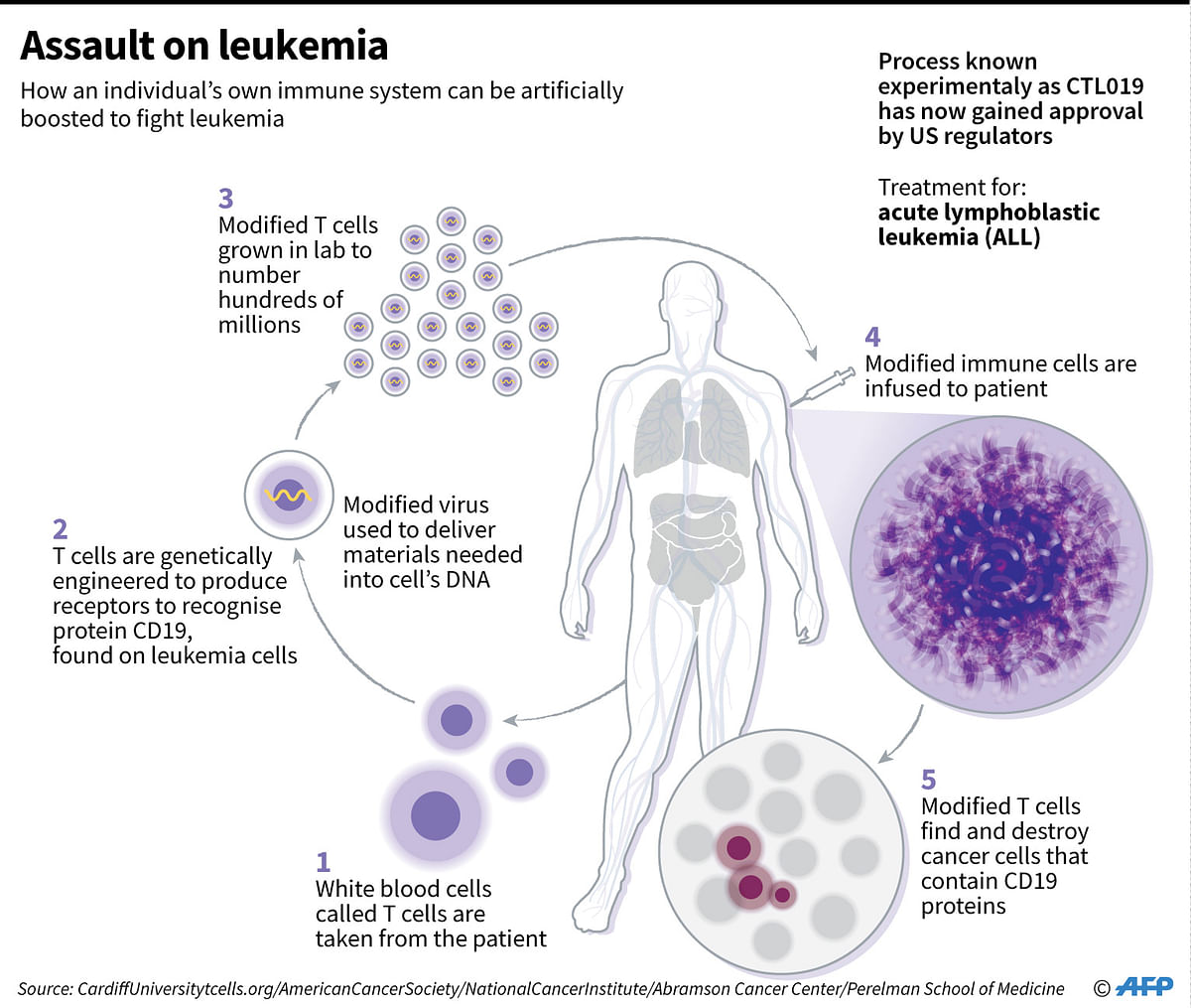 Graphic on an immunotherapy treatment for acute lymphoblastic leukemia, a process that gained approval for use in the United States Wednesday. AFP