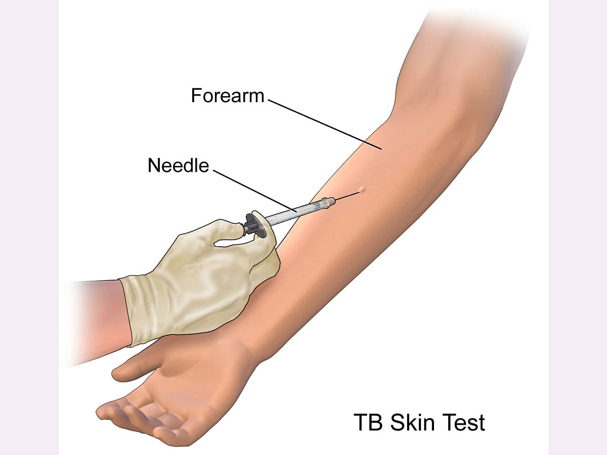 TB test image