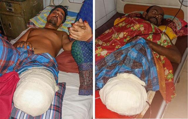 Faruk Hossain and Ashraful Islam undergoing treatment at NITOR after losing their legs in police custody on Saturday. Photo: Prothom Alo
