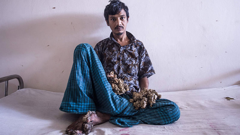 Abul Bajandar , 28, dubbed `Tree Man` for massive bark-like warts on his hands and feet, sits at Dhaka Medical College Hospital in Dhaka on 24 June, 2019. Photo: AFP