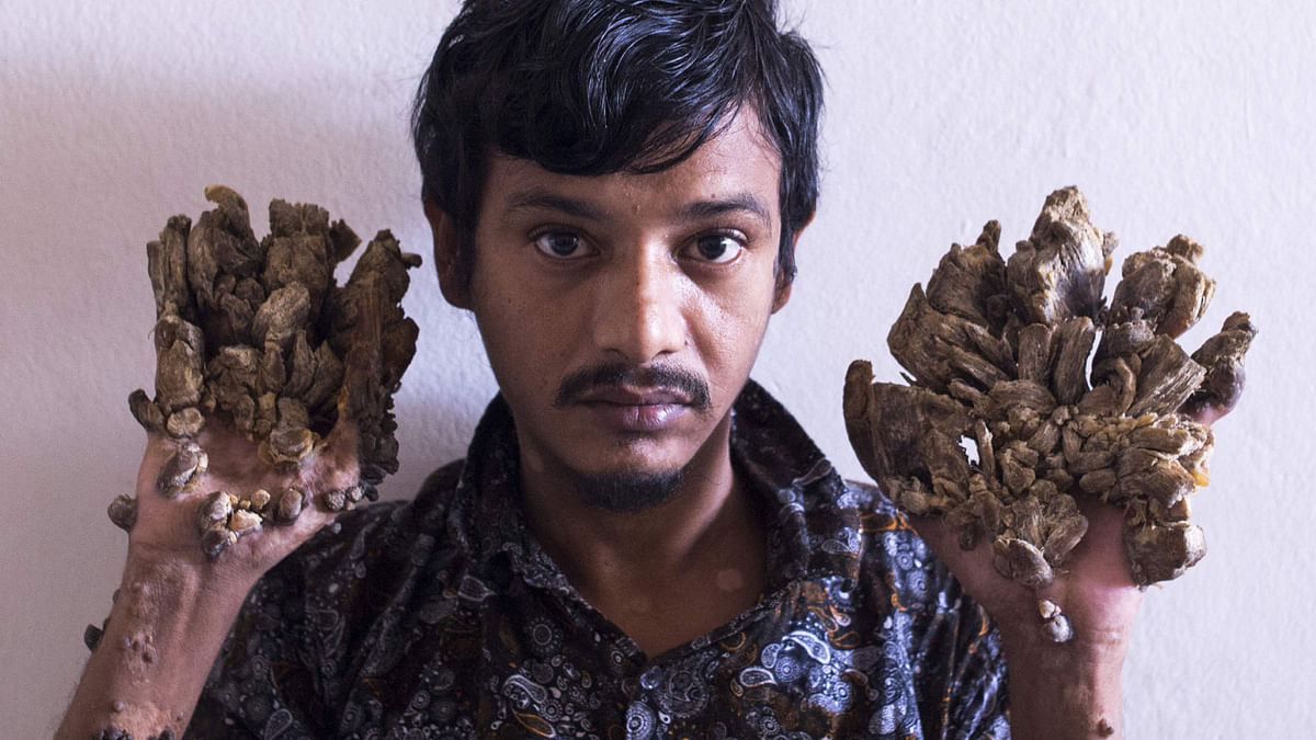 Abul Bajandar , 28, dubbed `Tree Man` for massive bark-like warts on his hands and feet, sits at Dhaka Medical College Hospital in Dhaka on 24 June, 2019. Photo: AFP