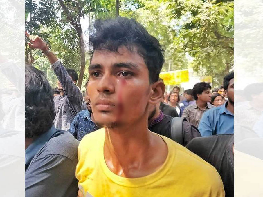Asif Mahmud, one of the protesters, sustains an injury in one of his eyes. He was taken to the university`s medical centre. Photo: UNB