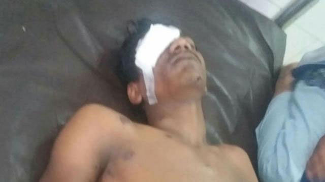 A youth’s eye was damaged by rubber bullet fired allegedly by police during a clash between law enforcers and residents of Mohammadpur Geneva Camp on Saturday. Photo: Prothom Alo
