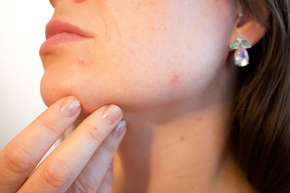 A new study finds poor dietary habits, increased stress and harsh skincare routines are among the most significant factors associated with acne. Photo: Pixabay