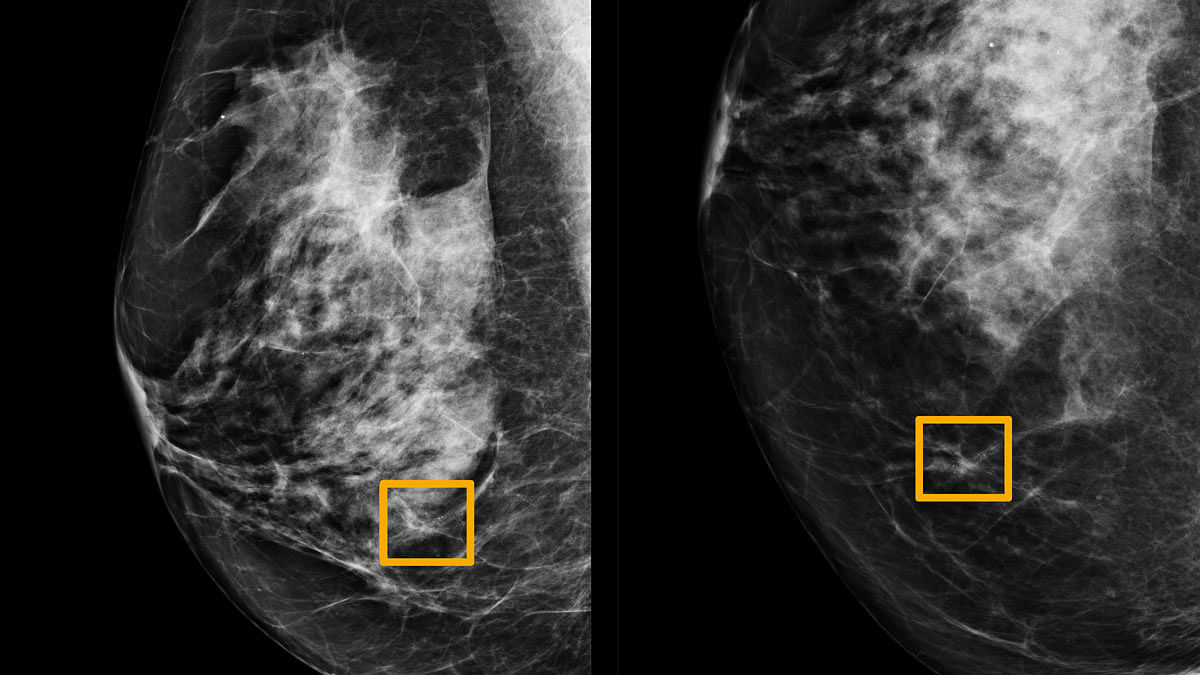 A yellow box indicates where an artificial intelligence (AI) system found cancer hiding inside breast tissue, in an undated photo released by Northwestern University in Chicago on 1 January. Photo: Reuters