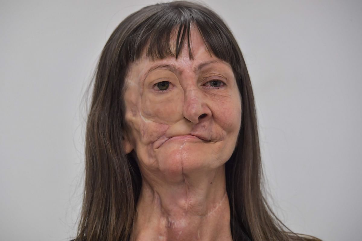 Denise Vicentin, who lost her right eye and part of her jaw to cancer, poses after receiving a digitally-engineered prosthesis, in Sao Paulo, Brazil, on 3 December 2019. Photo: AFP